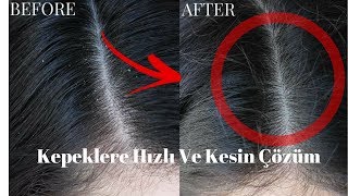 Download lagu 2 Yıkamada Kepekten Kurtulma Hızlı ve Kesin çözüm 2 Yıkamada Kepekten Kurtulma Hızlı ve Kesin çözüm