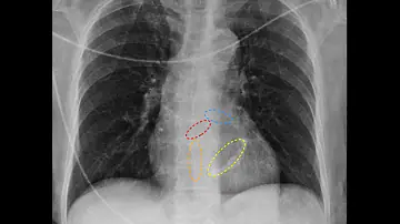 O que significa valva mitral Espessada?