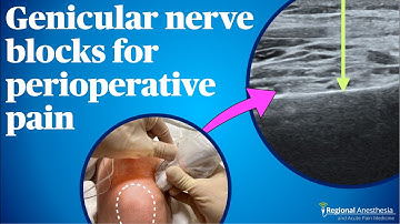 Ultrasound Guided Genicular Nerve Blocks