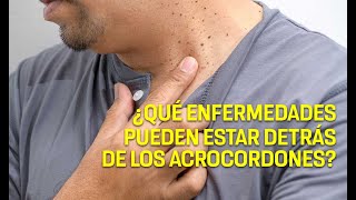 Papiloma cutáneo: signo de algunas enfermedades - UNAM Global