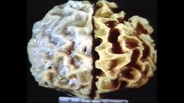 Creutzfeldt Jakob Disease