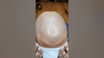 Scalp Micropigmentation (SMP) Client Session 2