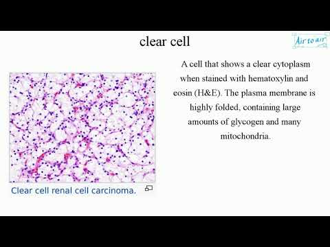 Video: Kas yra hialinizuojanti skaidrių ląstelių karcinoma?