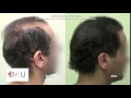 Patient is thrilled after his 11000 graft  hair repair surgery  results at 7 months