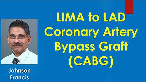 LIMA to LAD Coronary Artery Bypass Graft CABG