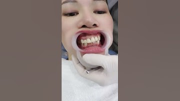 Răng Khấp Khểnh Có Bọc Răng Sứ Thẩm Mỹ Được Không?? Răng Khấp Khểnh Làm Răng Sứ?? Làm Đẹp #rangsu