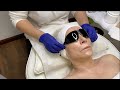 Cool Laser Treatment Tutorial For Aging, Pigmented and Acne Prone Skin