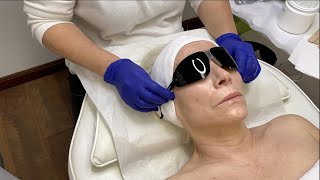 Cool Laser Treatment Tutorial For Aging, Pigmented and Acne Prone Skin