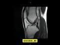 Dynamic MRI Of Knee Dynamic MRI Of Knee
