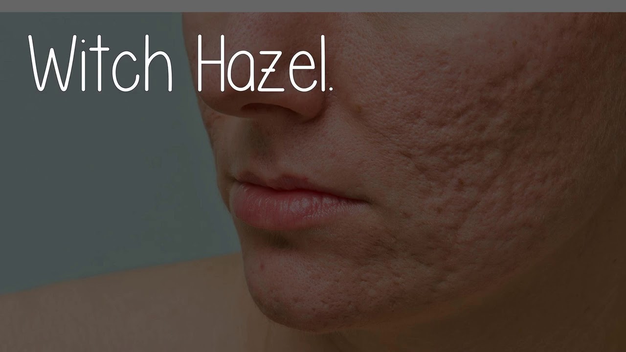 Are You Using Witch Hazel On Acne Scars? YouTube
