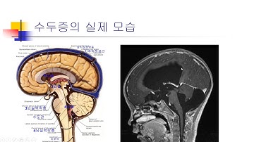 수두증 원인치료1