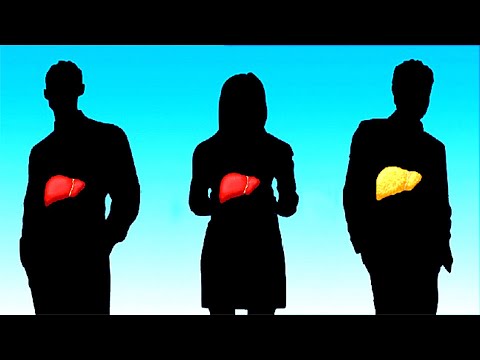 Signs That You Have a Fatty Liver!