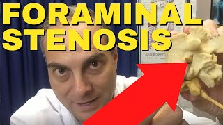 Ep23. Can Exercises Help Improve L4-L5 Foraminal Stenosis (L4 L5 Disc Bulge) Dr. Walter Salubro