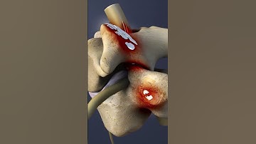 Spinal Conditions of the C7-T1 Spinal Motion Segment