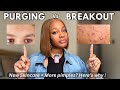 Still Breaking out? How to Tell if it’s Acne purging or a Real breakout