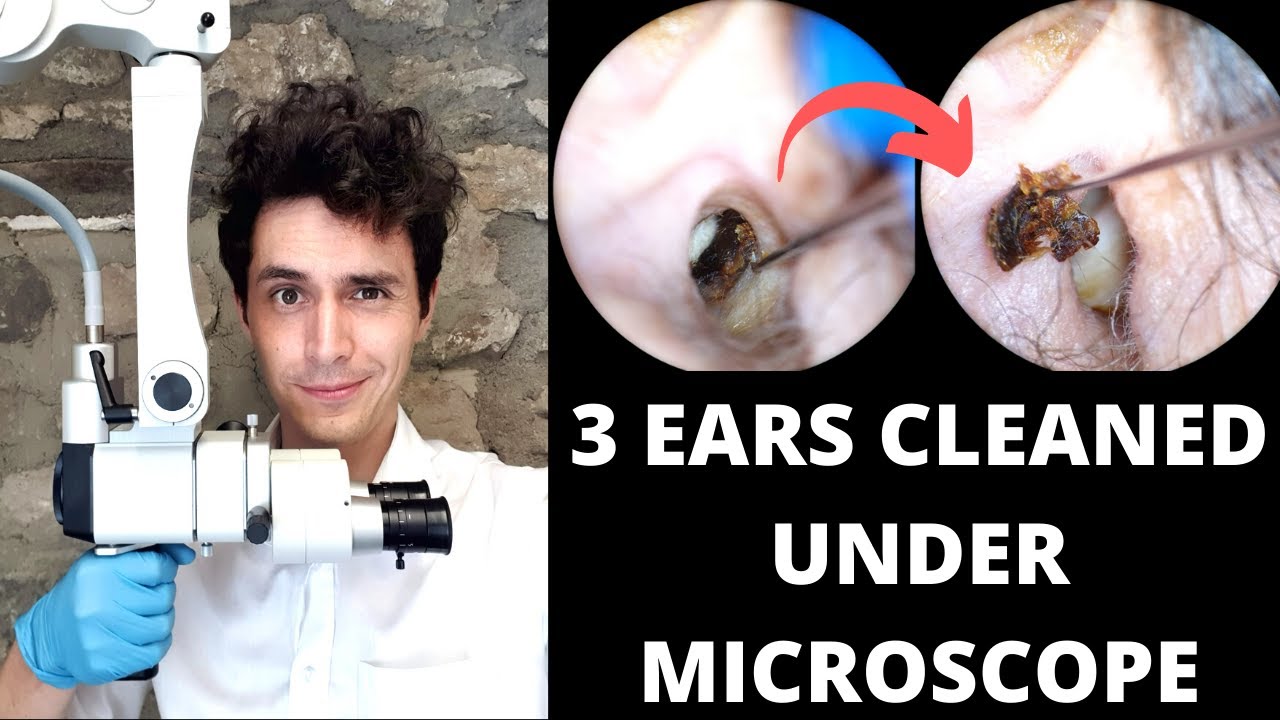 3 Microscopic Ear Wax Extractions (Video Capture Test) YouTube