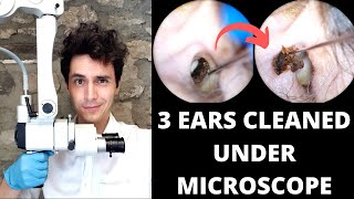 3 Microscopic Ear Wax Extractions (Video Capture Test)