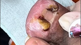 Ep_6501 Big ingrown toenail removal 👣 โอ้โห..หนูดูเล็บของหนูสิ 😄 (clip from Thailand)