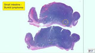 Small intestine: Burkitt lymphoma - Virtual microscopy (Talking slide)