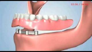 Treatment Options for All Missing Teeth