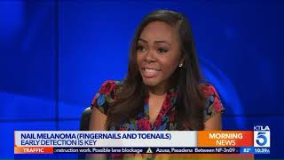 Nurse Alice on KTLA: What is nail melanoma?
