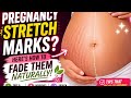 Pregnancy Stretch Marks Guide | स्ट्रेच मार्क्स का होतात?”👩‍⚕️Hormonal &amp; Skin Changes”