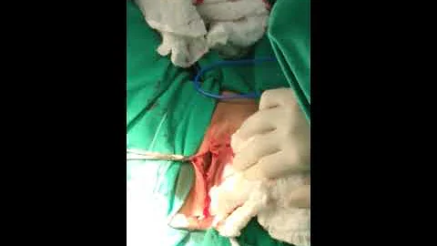 Quanto custa cirurgia íntima a laser?