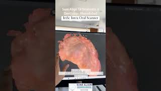 Intra oral scanning of soft tissue. Edentulous Maxilla Scan with Irific Scanner. screenshot 2