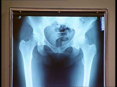 heeg opinion 13 ganz osteotomie minne heeg youtube heeg opinion 13 ganz osteotomie minne heeg youtube