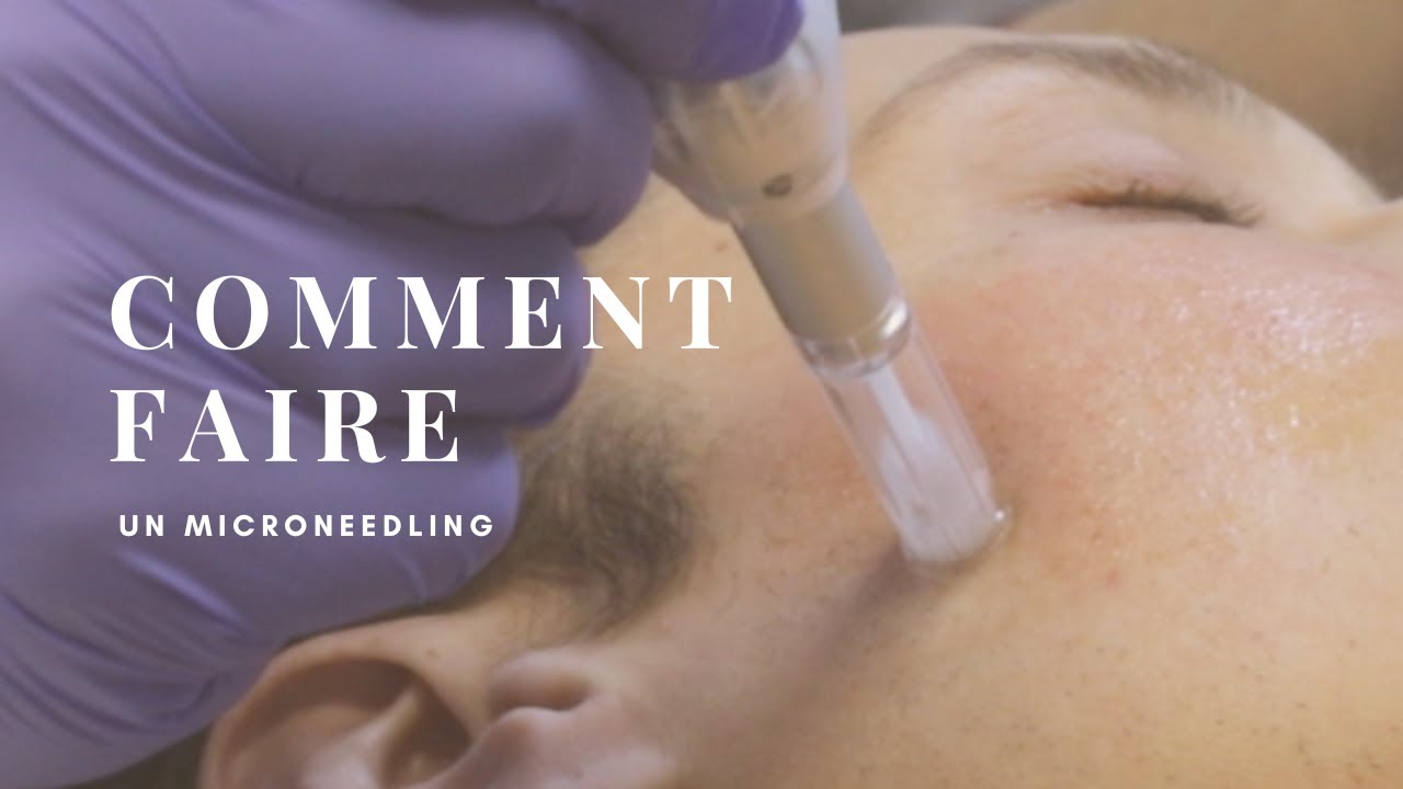 Le Microneedling: Découvrez le Secret pour une Peau Radieuse Révélé par l'École d'Esthétique Avancée