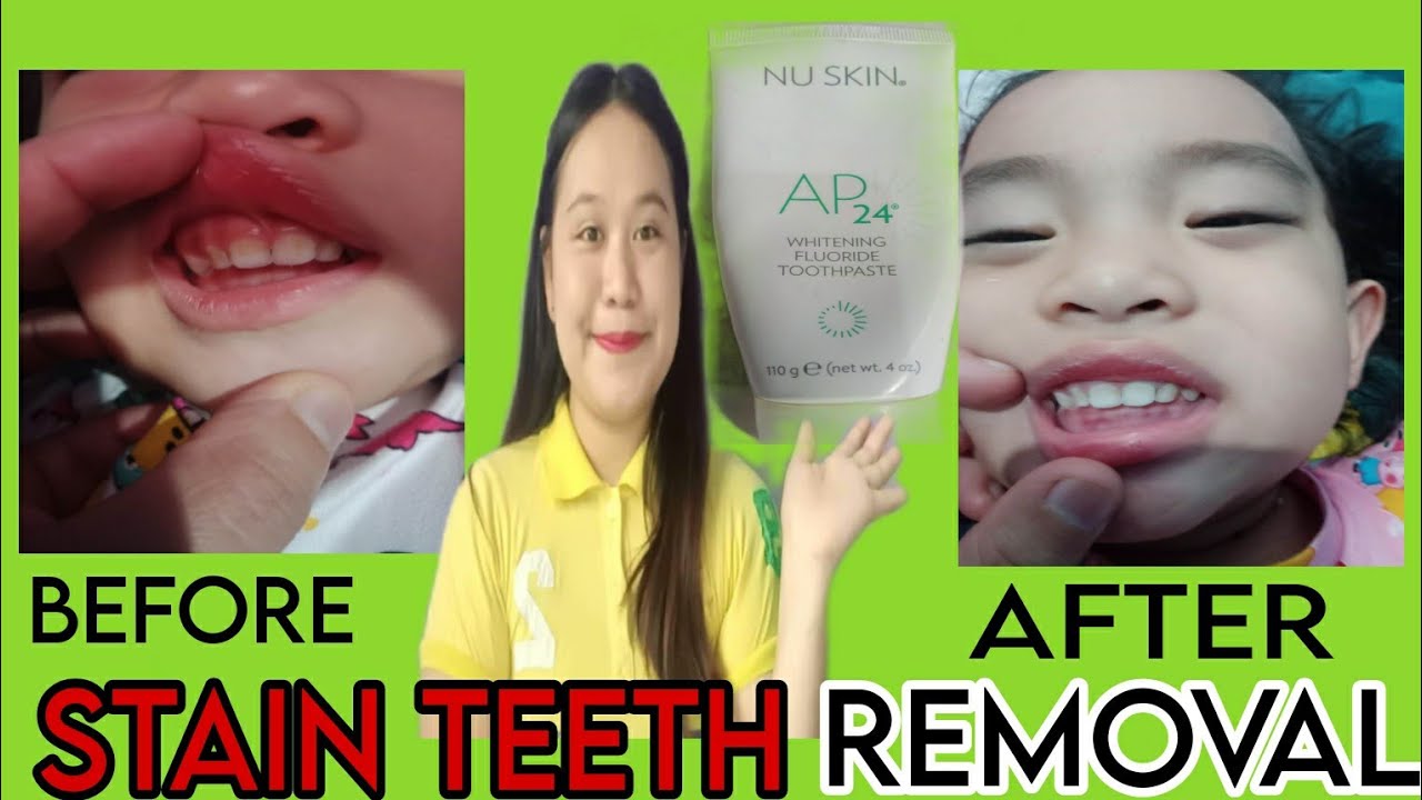 HOW TO REMOVE BABY STAIN TEETH |  NU SKIN AP 24 FLOURIDE WHITENING TOOTHPASTE | STAIN TEETH REMOVAL