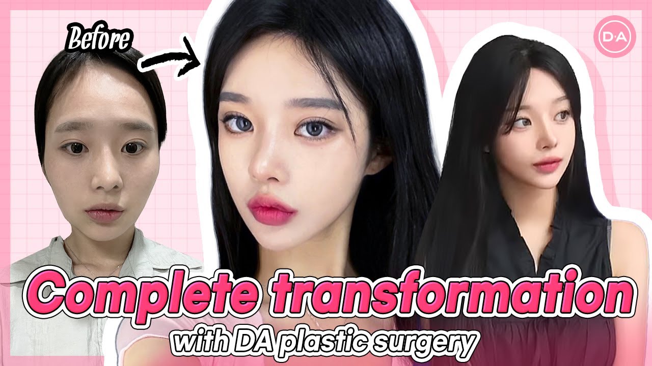 [Plastic Surgery Korea] Complete Transformation! YouTube