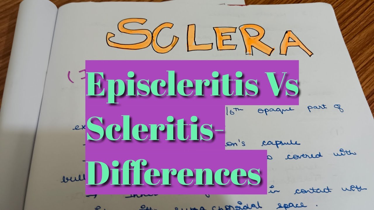 Episcleritis Vs Scleritis Sclera Differences Between Episcleritis for Difference Between Scleritis And Vs Episcleritis