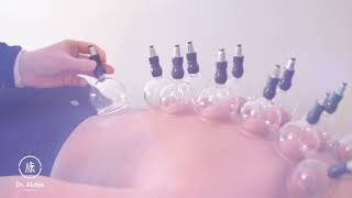 Cupping-Dr.abbie