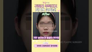 이거 하면 얼굴 진짜 -5cm 작아보인다.. 요정귀 필러 전후 #shorts
