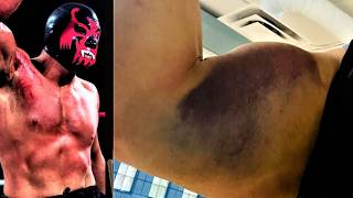 Hannibals WORST Injuries: Inside His Most Brutal Matches