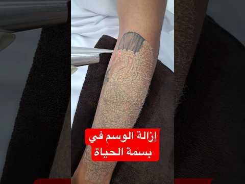 ازالة الوشم في مركز بسمة الحياة الطبي
