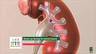 Everything You Need to Know: Kidney Stone Analysis