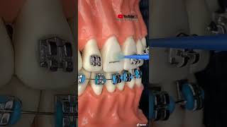 TUTORIAL: “INSTALACIÓN de BRACKETS metálicos”
