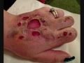 halloween FX tutorial 3rd degree burn