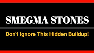 Smegma Stones The Shocking Truth