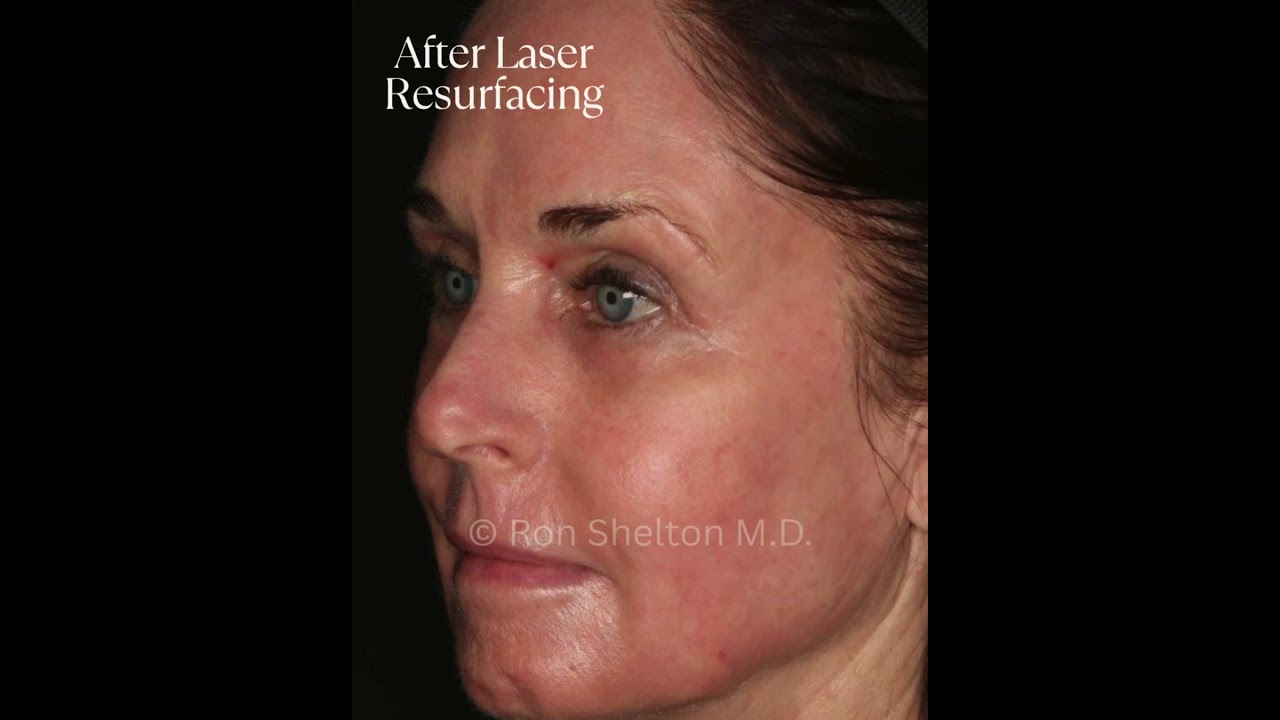 Laser Resurfacing with Sciton Contour Erbium | Rejuvenate Aging Skin with Dr. Ron Shelton