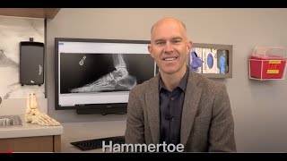 What to Expect After Hammertoe Surgery