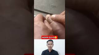 Cabut Duri Di Dalam Daging 463 fyp short shorts feedshorts trending splinter