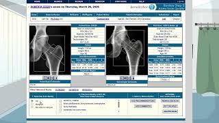 Reading a DXA bone density scan with BoneStation.