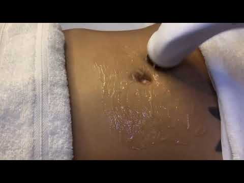 Radiofrequência Facial — Unolaser