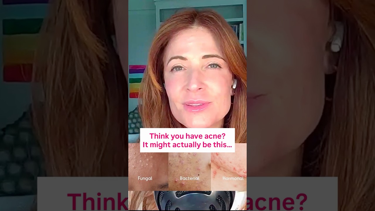 Think you have acne? It might actually be this…