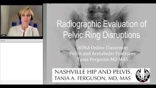 Radiographic Evaluation of Pelvic Ring Disruptions