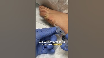 Fish Hook Removal