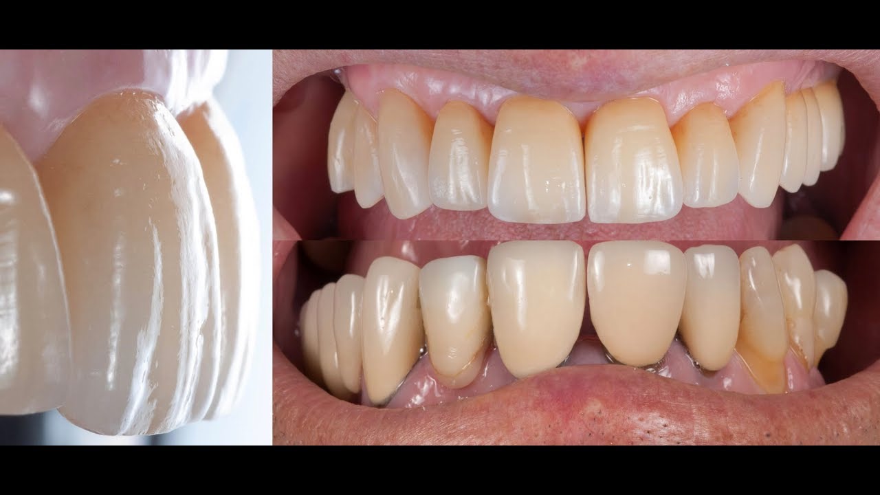 CT Graft + "S" Roll Flap YouTube